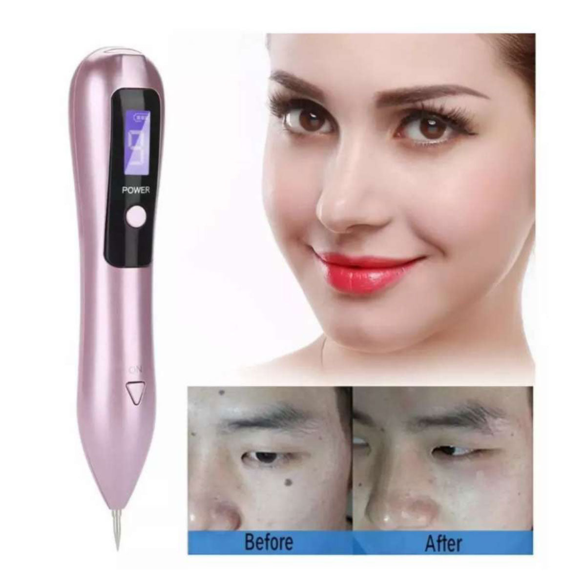 Cauterizador Quita Verrugas con Pantalla LED